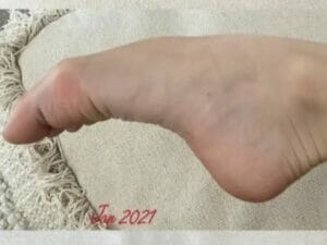 Does Ballet Ruin Your Feet